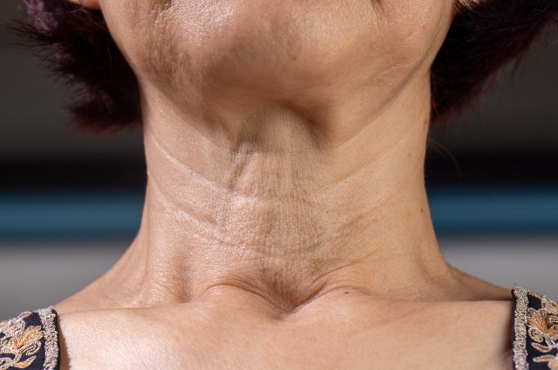 Vrásky na krku můžete vyhladit přirozeně: Tyto triky mají viditelné výsledky